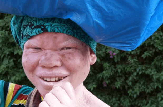 La piel de los Albinos