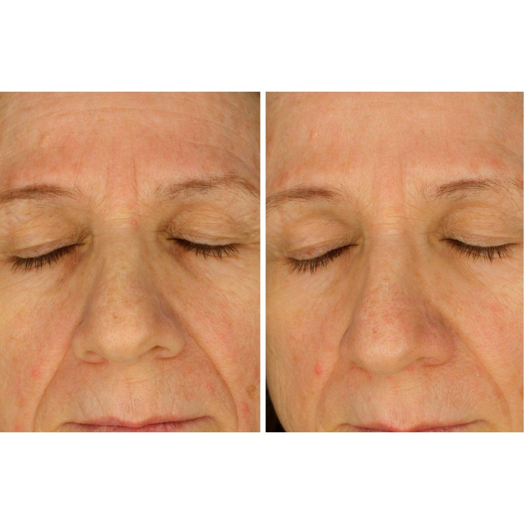 Imagen de antes y después mostrando mejora en rojeces, imagen de FARMA DORSCH de RETINOL + Vitamin C