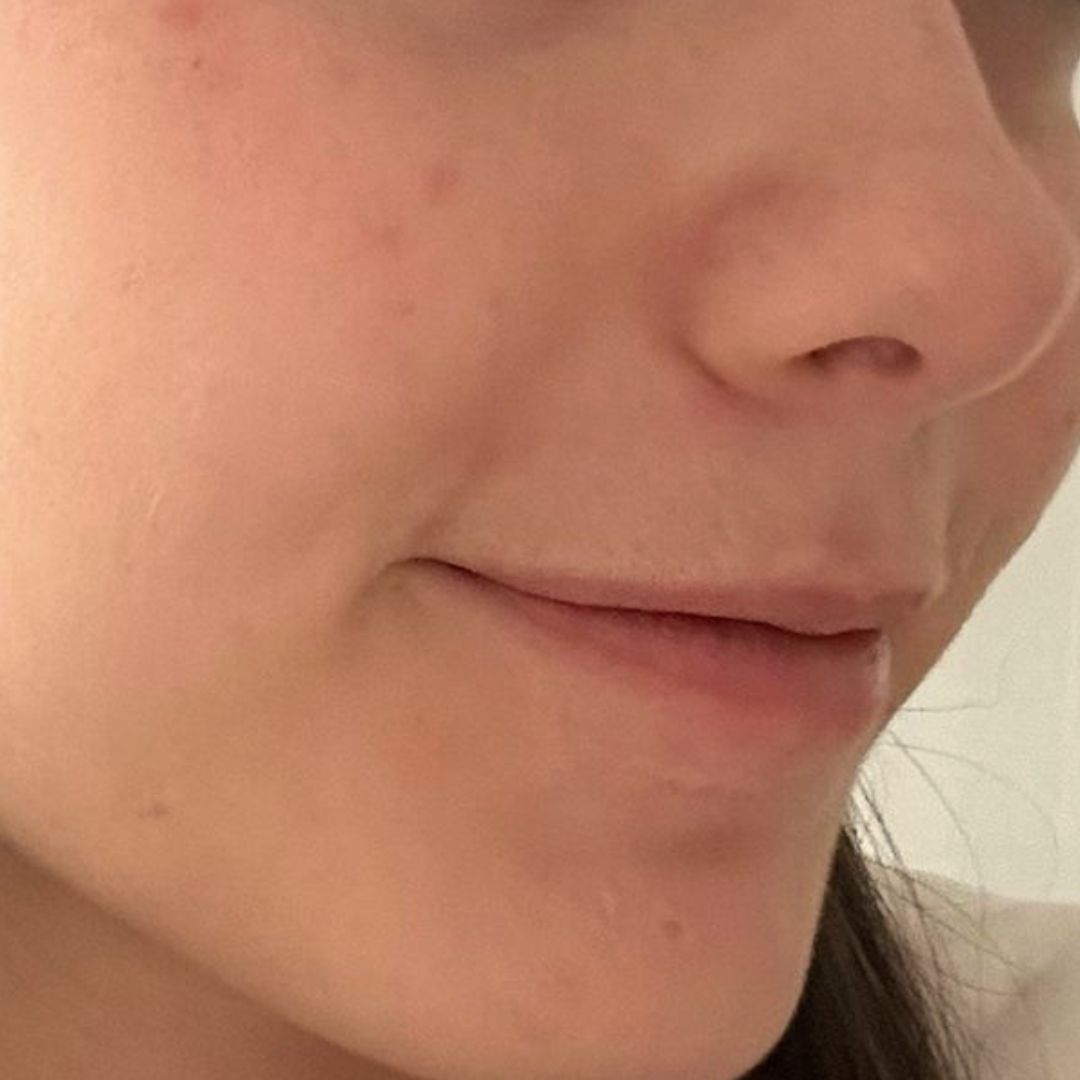 Chica con imagen de marcas por acné, de FARMA DORSCH para STOP AKEIK antes y depues 