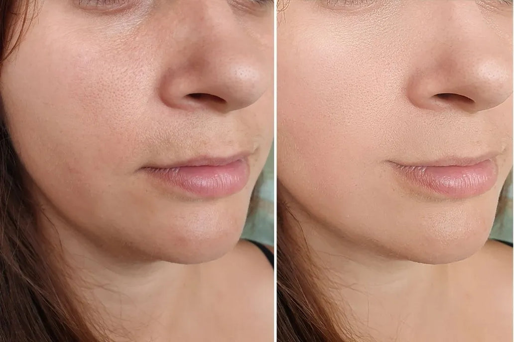 antes y después FARMA DORSCH piel con poros menos visibles y textura más uniforme en el rostro