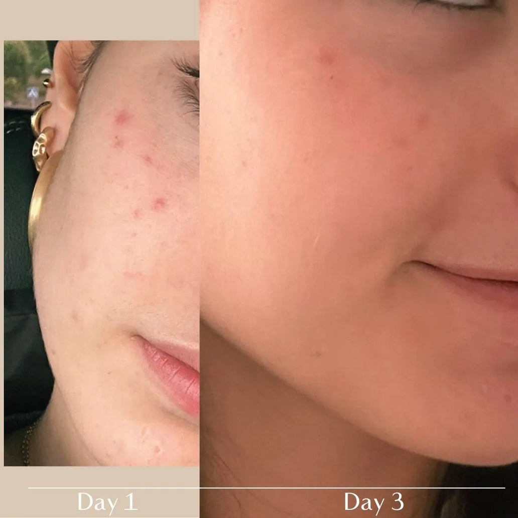 antes y después Stop Akneik FARMA DORSCH mejora visible de granos y rojeces tras tres días de uso