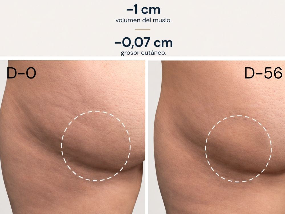 Test de eficacia en celulitis de Meso Slim de FARMA DORSCH en su activo principal