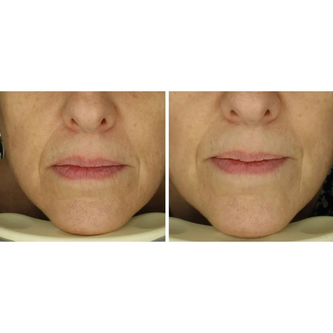 antes y después Suerum FARMA DORSCH sérum ultra hidratante con efecto lifting y mejora visible de la piel