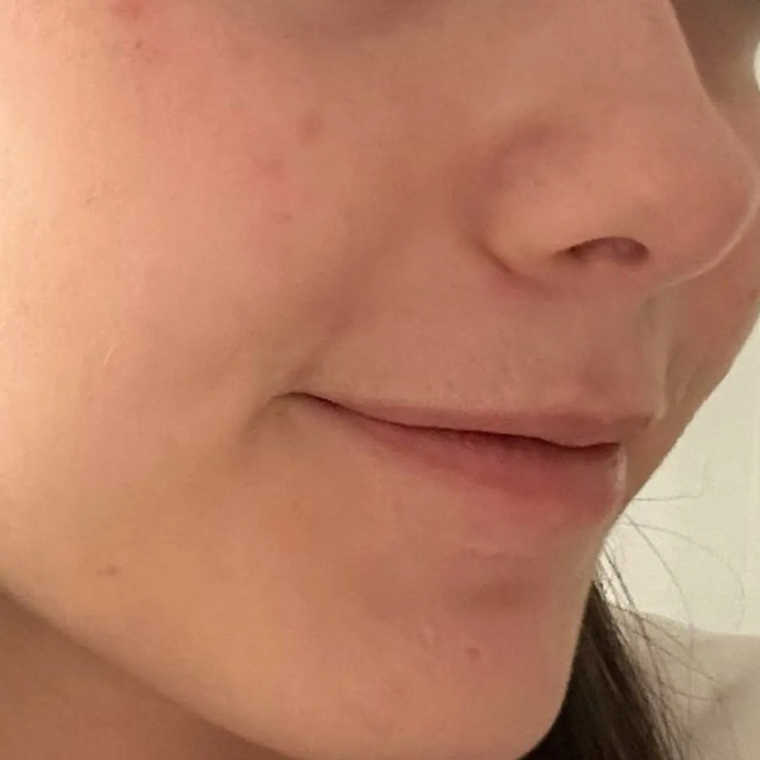 Chica con imagen de marcas por acné, de FARMA DORSCH para STOP AKEIK antes y depues 