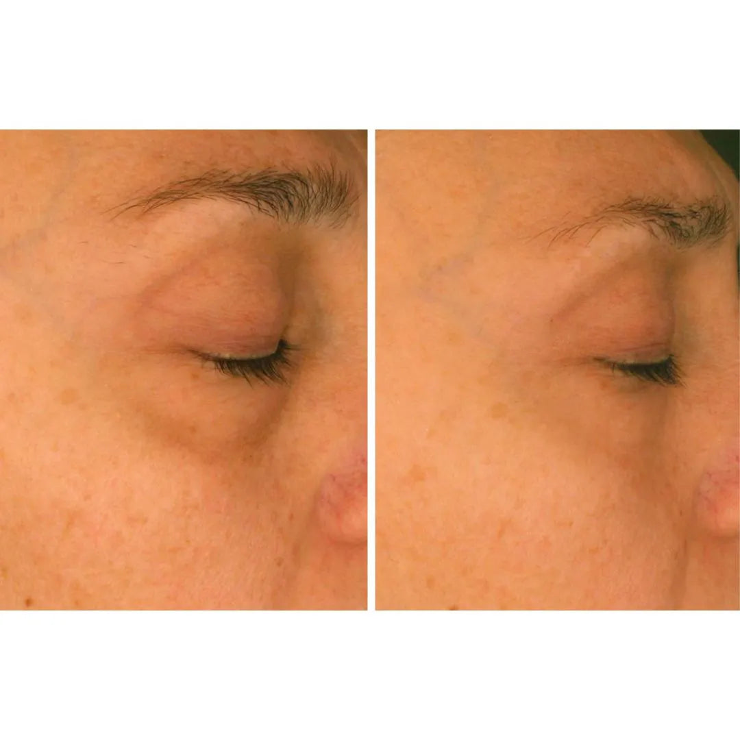 comparativa antes después tratamiento ojos FARMA DORSCH disminución de bolsas y tono más uniforme